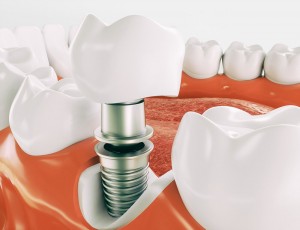 implantacziya-zubov-pod-klyuch-v-moskve