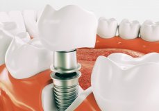 Имплантация зубов в эпоху современной стоматологии